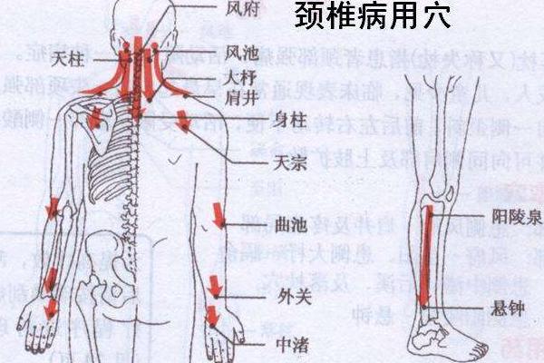 颈椎病刮痧有用吗 颈椎病刮痧刮哪里