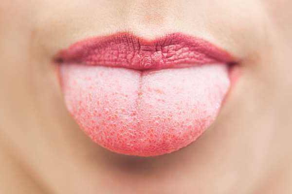 草莓舌苔是怎么回事 草莓舌怎么治疗