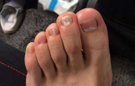 好多人灰指甲都不治正常吗3